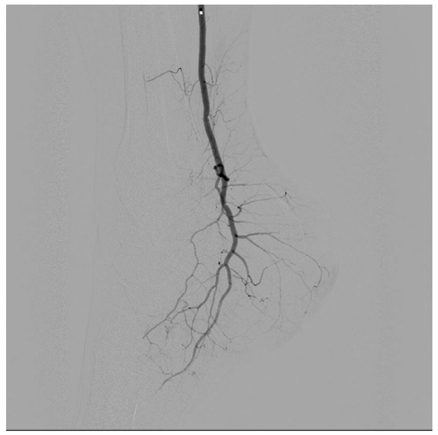 thrombolysis.png